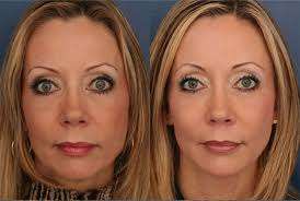 Plastic Surgeons Ozempic Face example